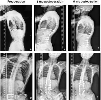 Entrapment of a metal foreign body in the heart during surgical procedure: A case report and literature review